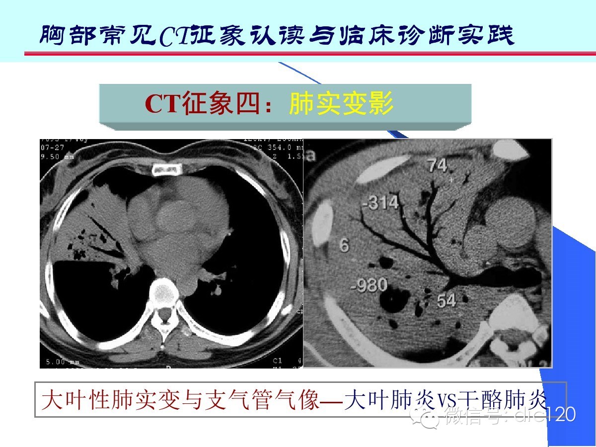 肺部CT十大征象诊断应用