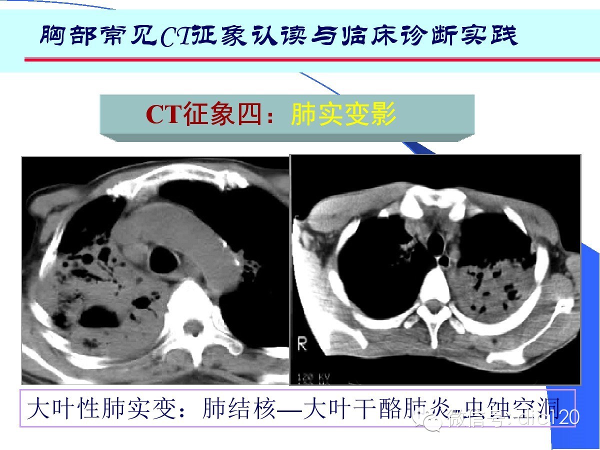 肺部CT十大征象诊断应用