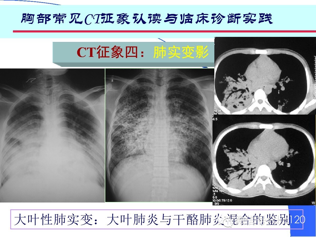 肺部CT十大征象诊断应用