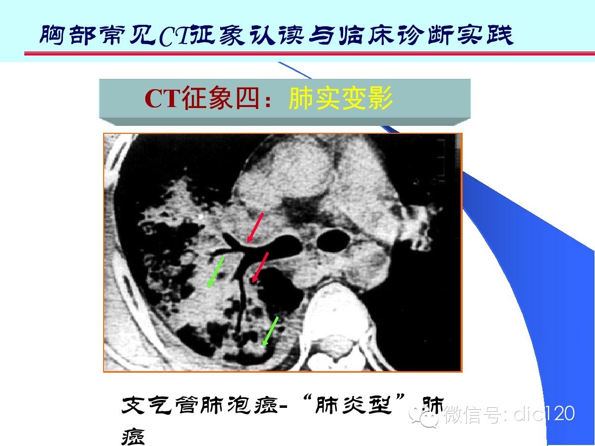 肺部CT十大征象诊断应用