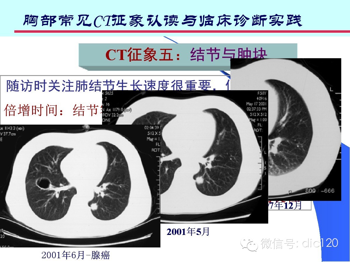 肺部CT十大征象诊断应用