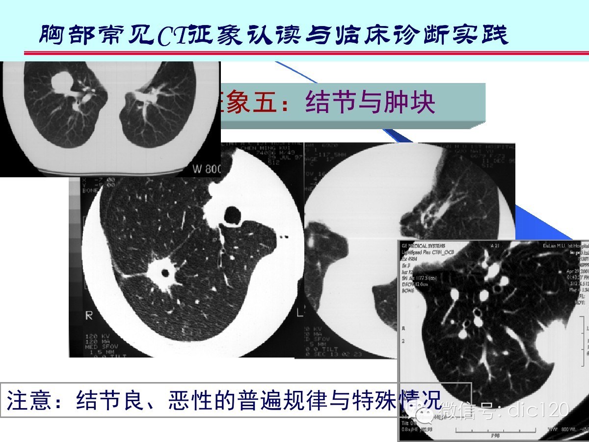 肺部CT十大征象诊断应用