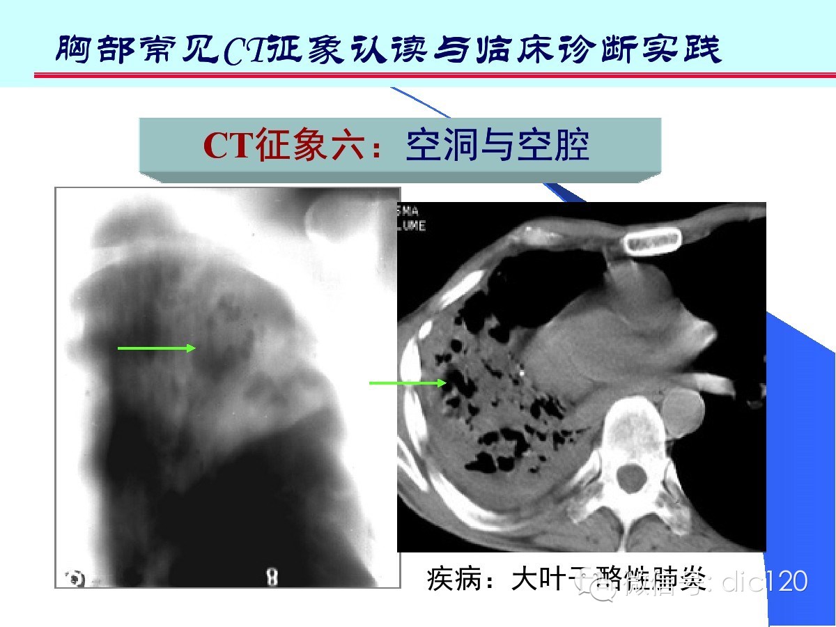 肺部CT十大征象诊断应用