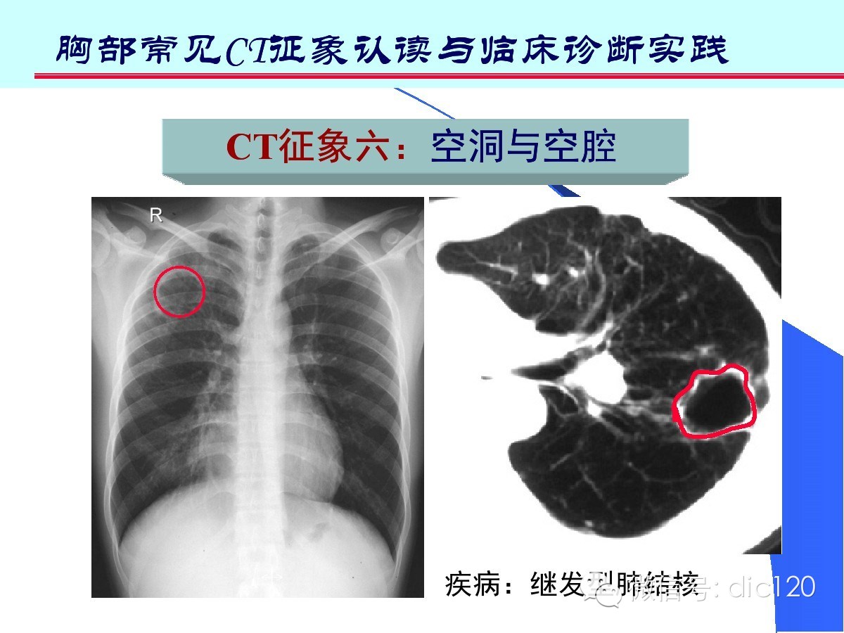 肺部CT十大征象诊断应用