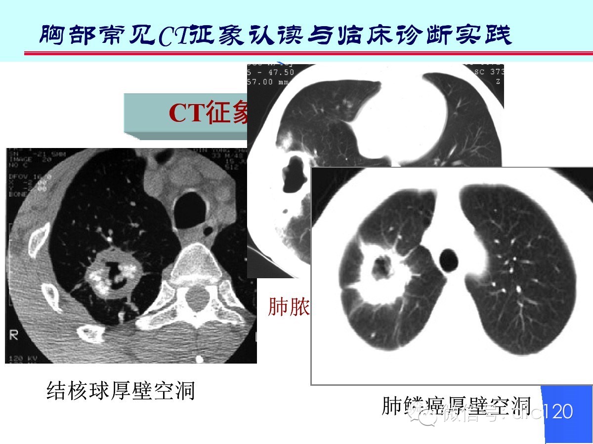 肺部CT十大征象诊断应用