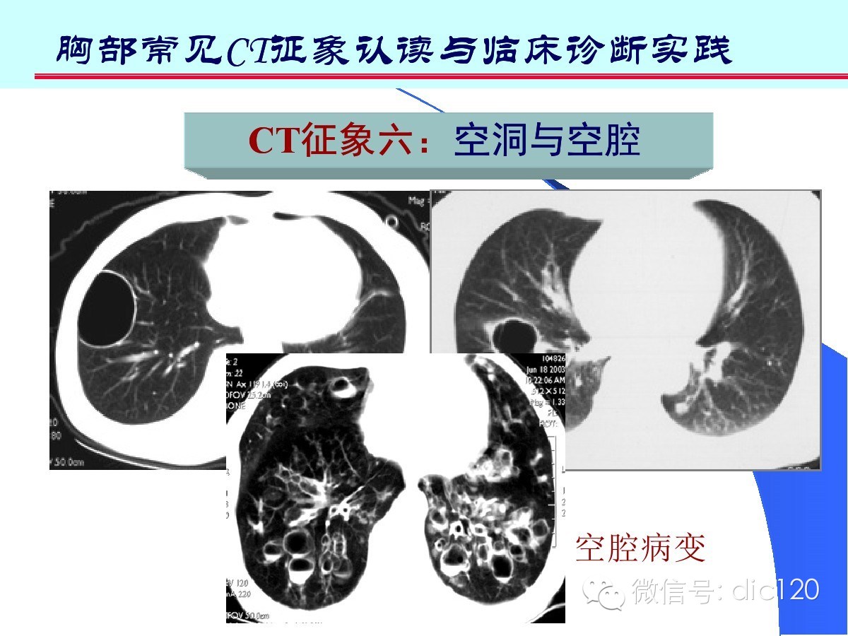 肺部CT十大征象诊断应用