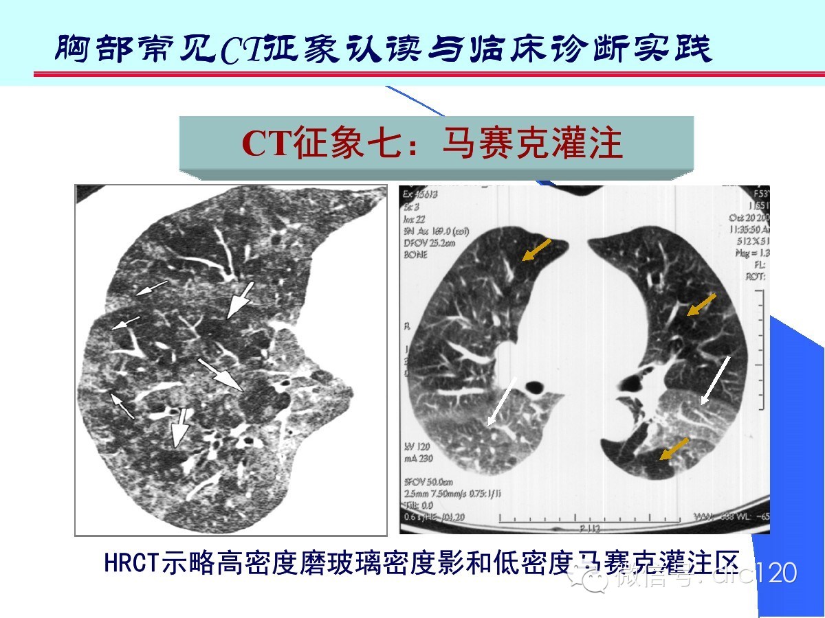 肺部CT十大征象诊断应用