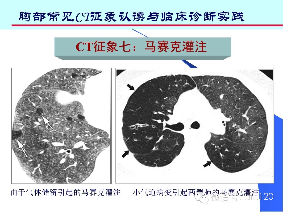 肺部CT十大征象诊断应用