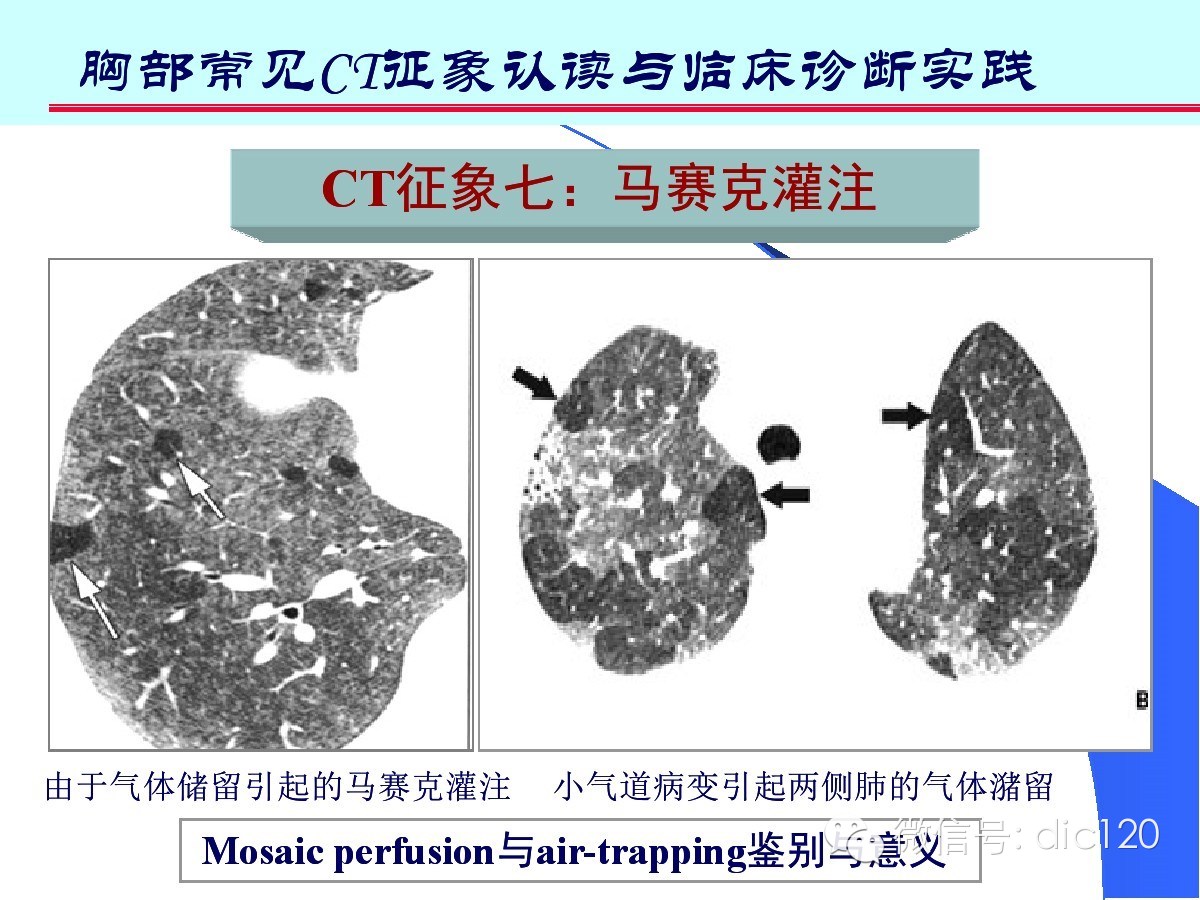 肺部CT十大征象诊断应用