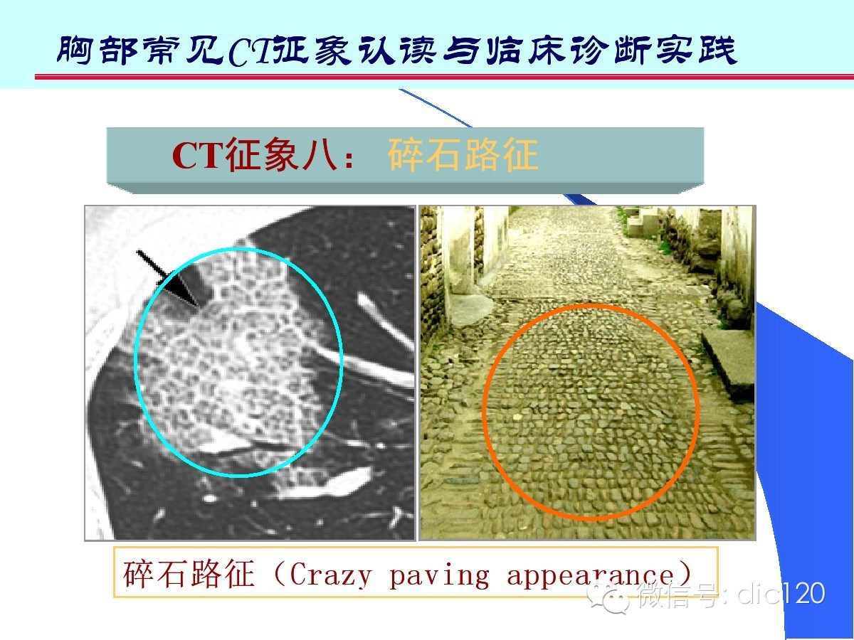 肺部CT十大征象诊断应用