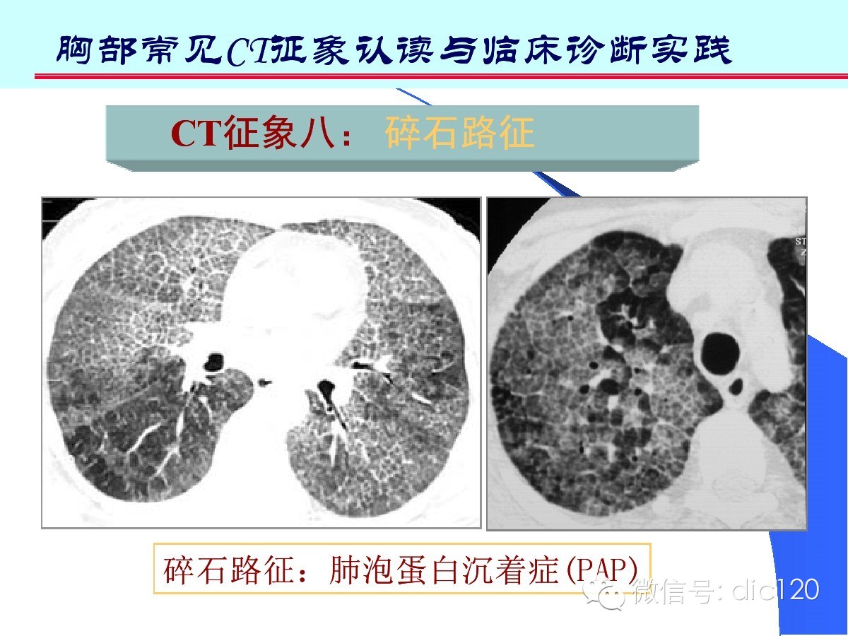 肺部CT十大征象诊断应用