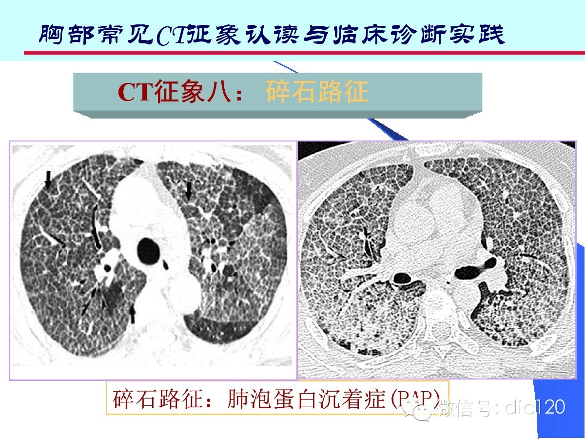 肺部CT十大征象诊断应用