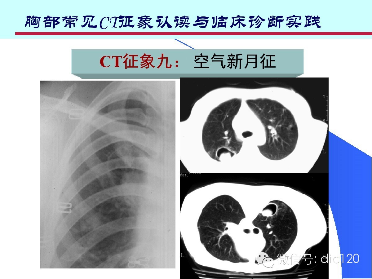 肺部CT十大征象诊断应用