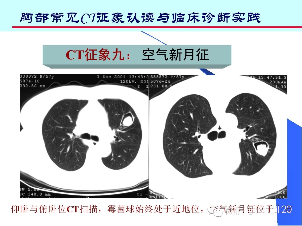 肺部CT十大征象诊断应用