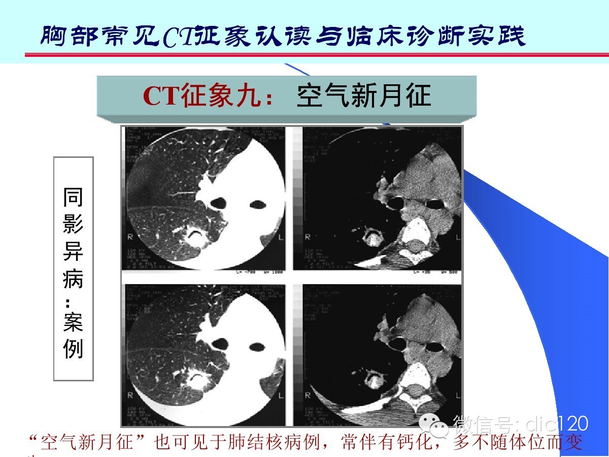 肺部CT十大征象诊断应用