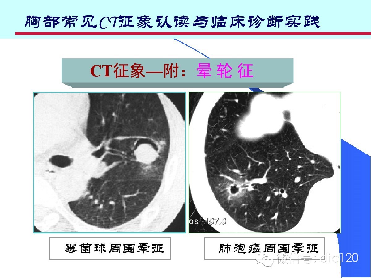 肺部CT十大征象诊断应用
