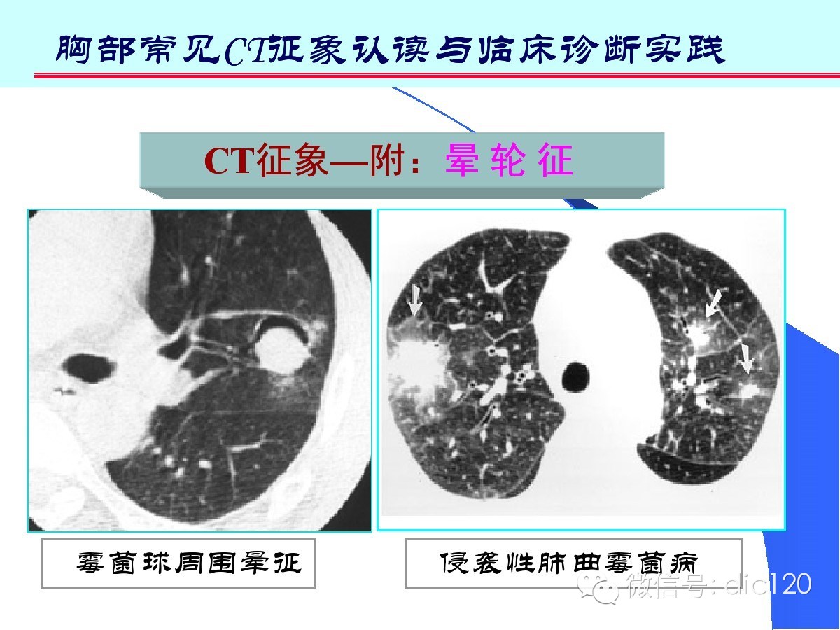 肺部CT十大征象诊断应用