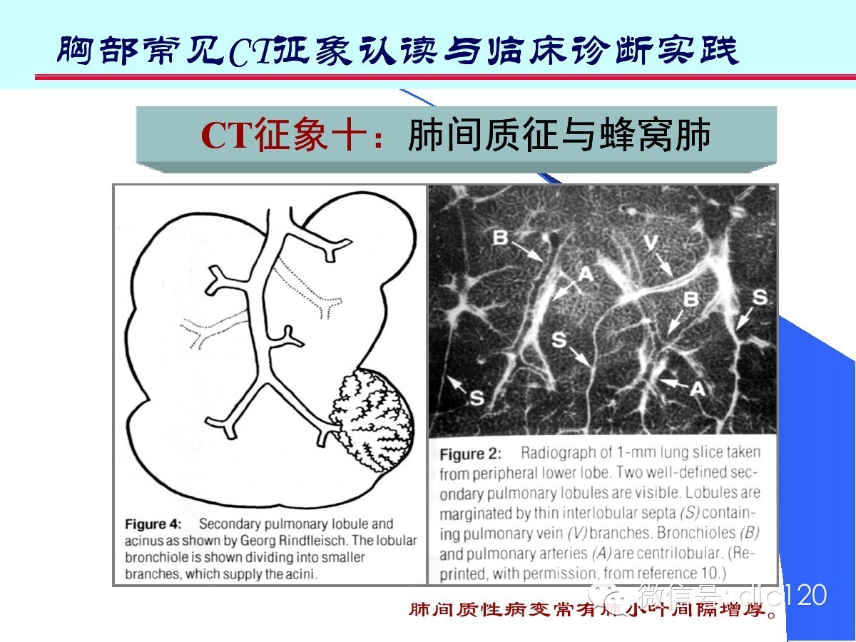 肺部CT十大征象诊断应用