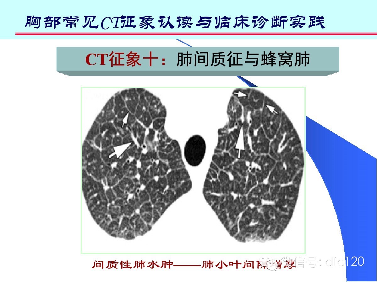 肺部CT十大征象诊断应用