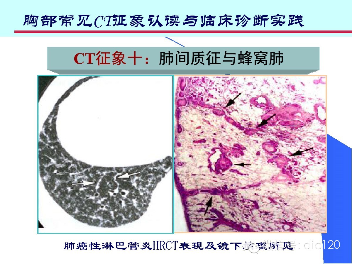 肺部CT十大征象诊断应用