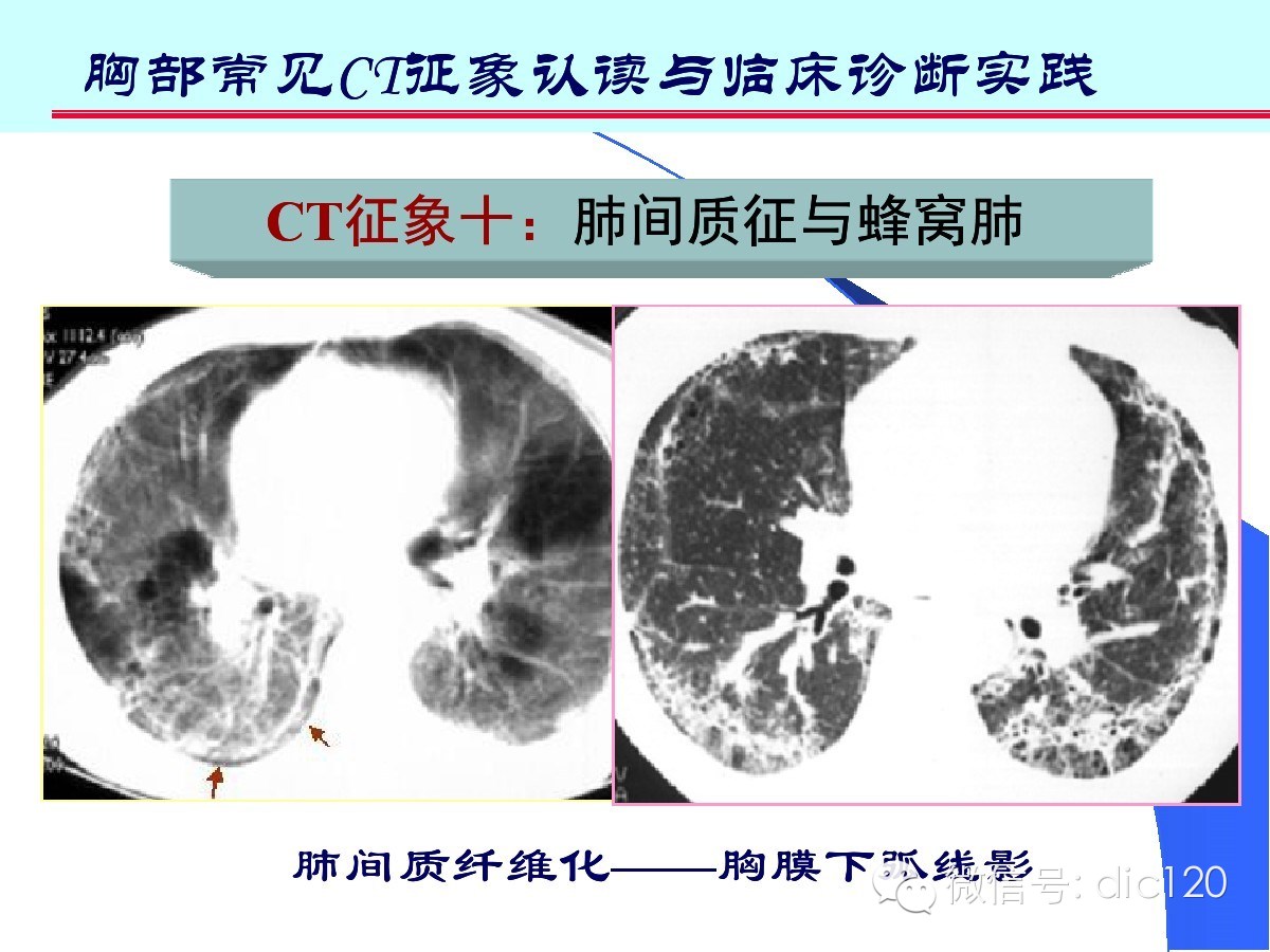 肺部CT十大征象诊断应用