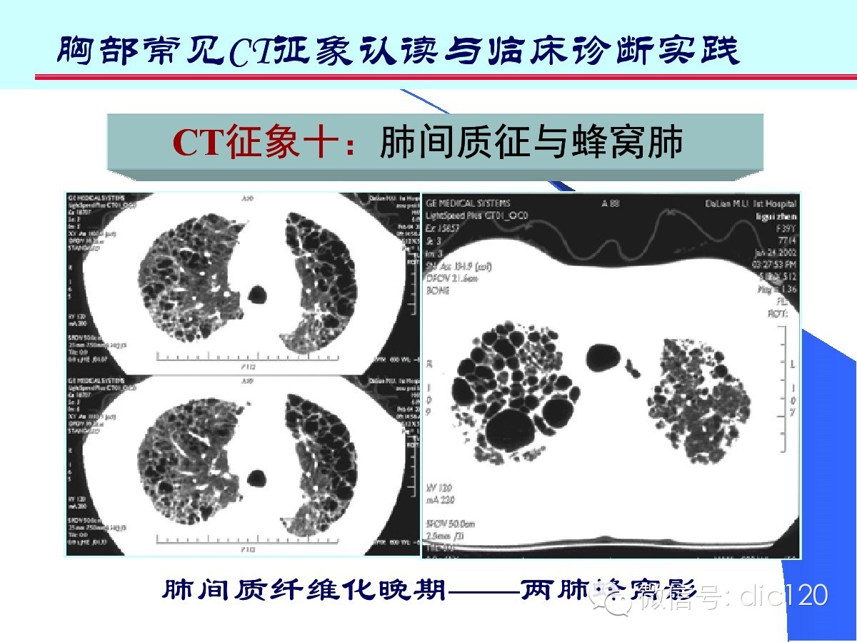 肺部CT十大征象诊断应用