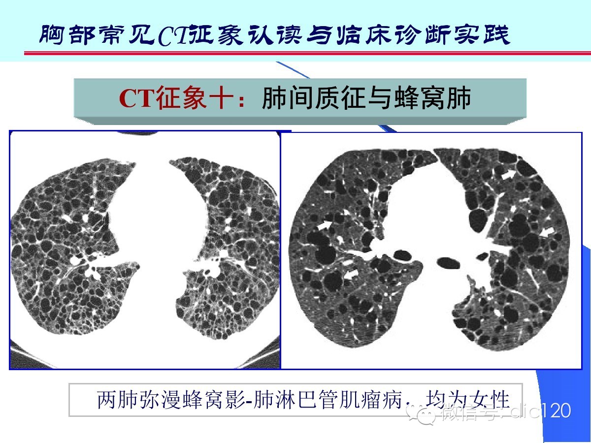 肺部CT十大征象诊断应用