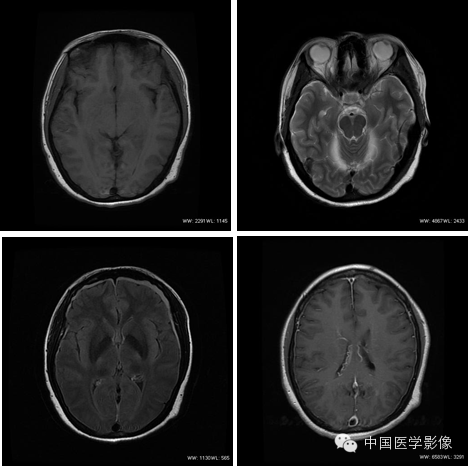 【病例学习】低颅压综合征一例MR诊断与鉴别
