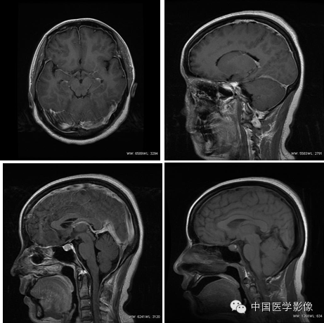 【病例学习】低颅压综合征一例MR诊断与鉴别 【病例学习】低颅压综合征一例MR诊断与鉴别