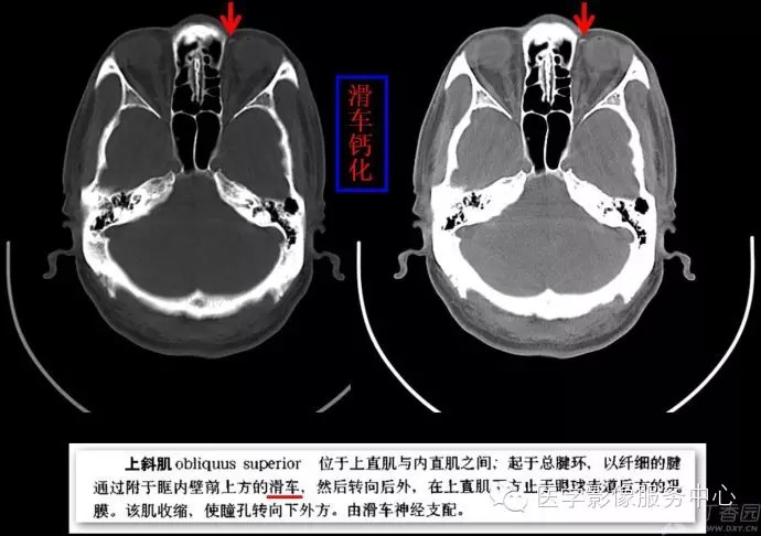 眼部滑车钙化