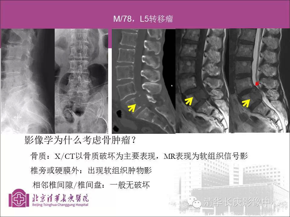 脊柱骨肿瘤的影像分析