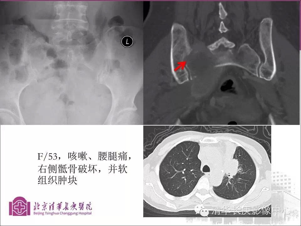 脊柱骨肿瘤的影像分析