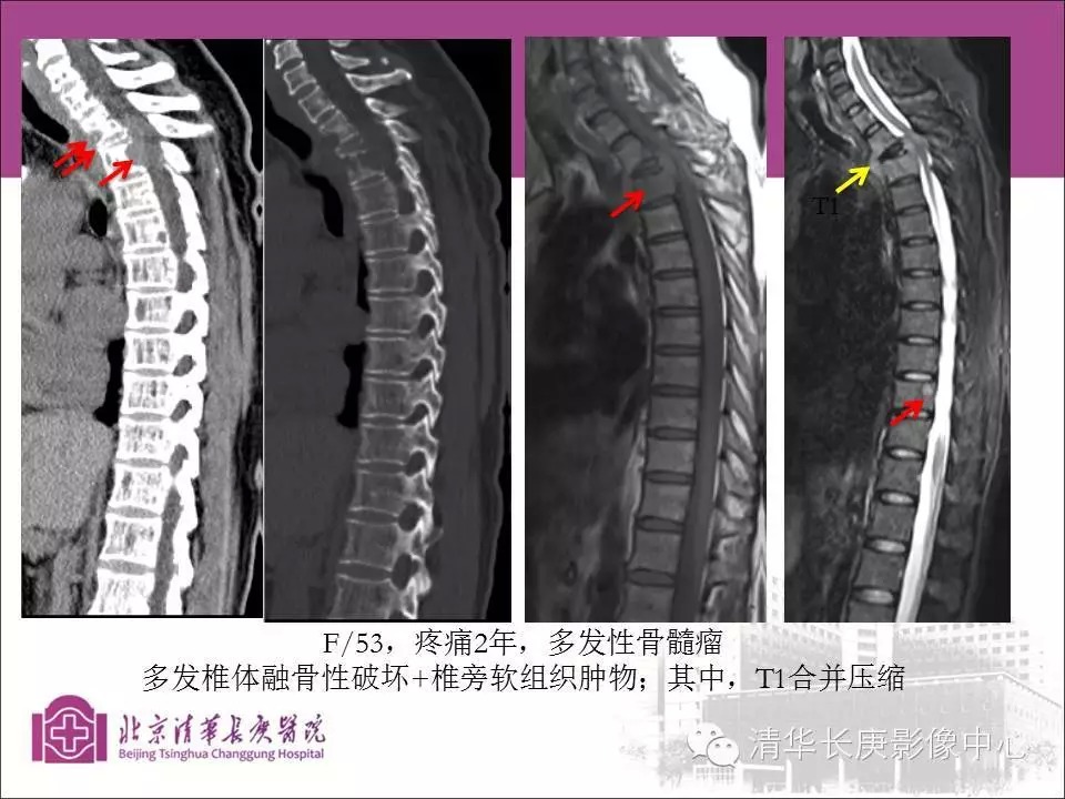 脊柱骨肿瘤的影像分析
