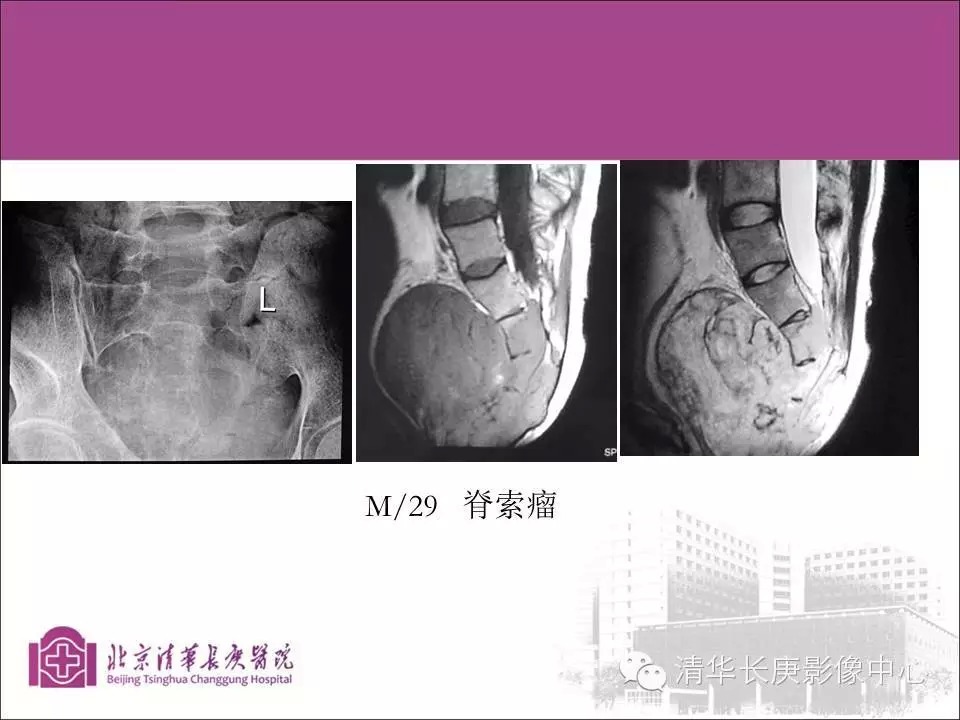 脊柱骨肿瘤的影像分析
