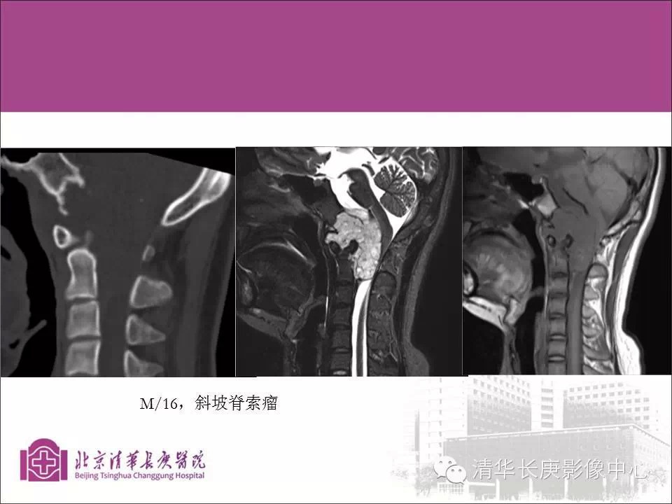 脊柱骨肿瘤的影像分析