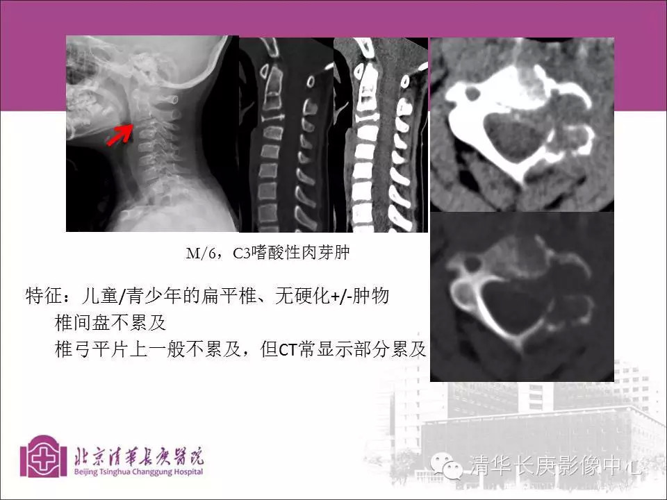 脊柱骨肿瘤的影像分析