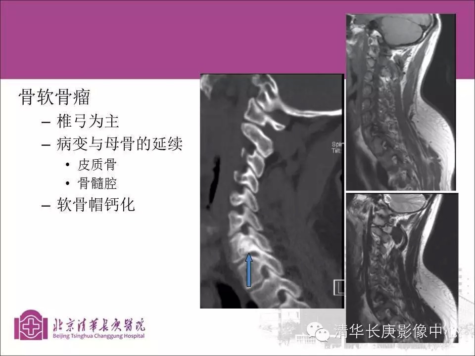 脊柱骨肿瘤的影像分析