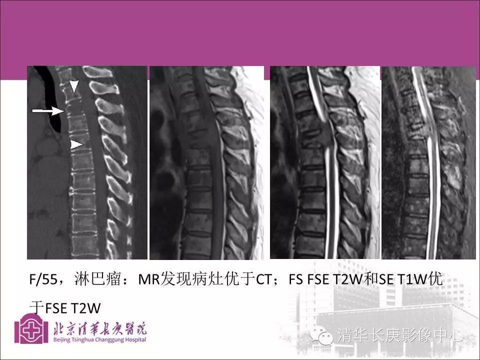 脊柱骨肿瘤的影像分析