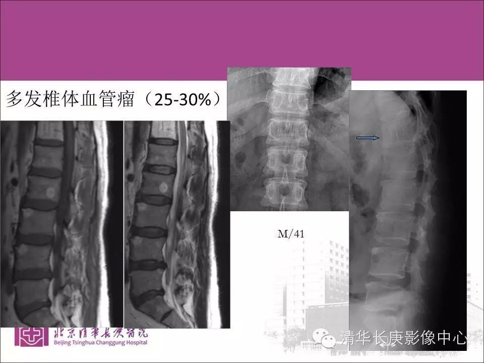 脊柱骨肿瘤的影像分析