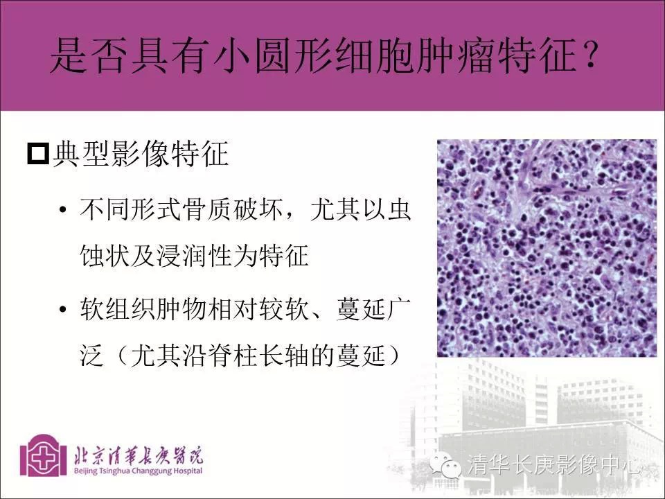 脊柱骨肿瘤的影像分析