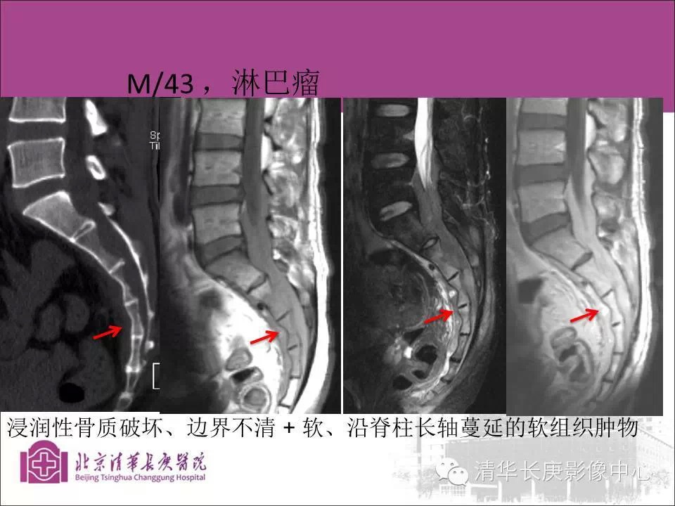 脊柱骨肿瘤的影像分析