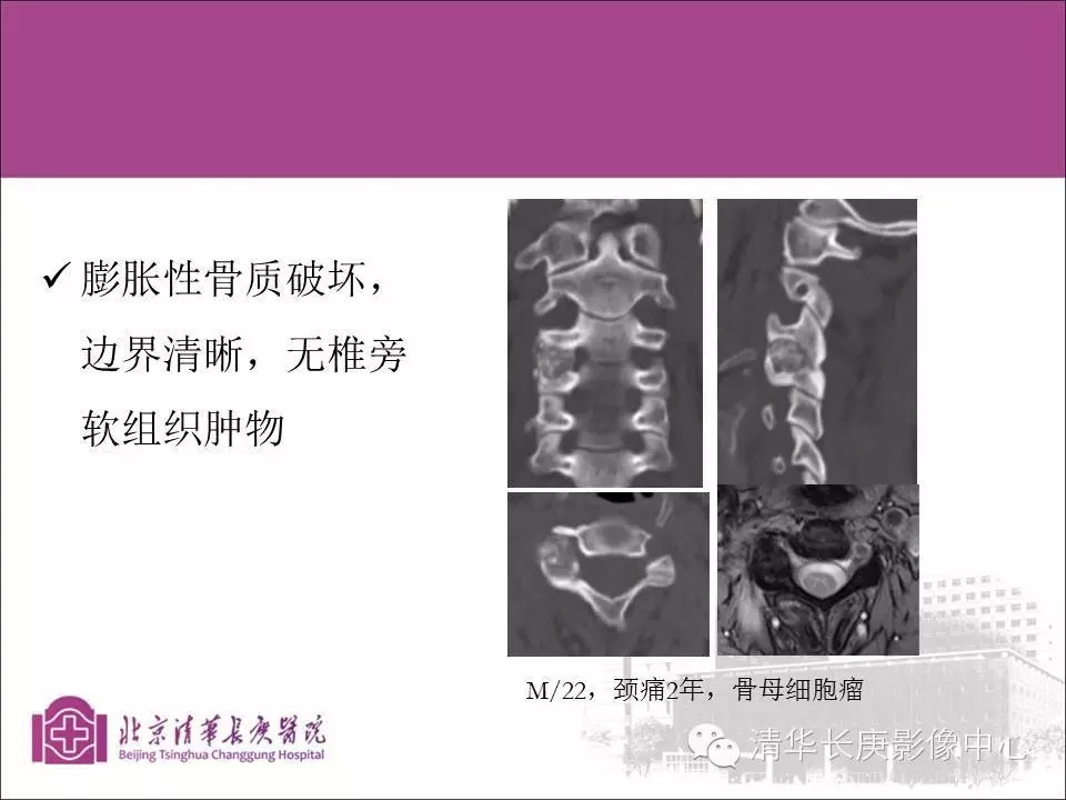 脊柱骨肿瘤的影像分析