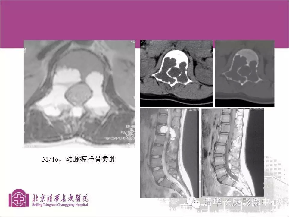 脊柱骨肿瘤的影像分析