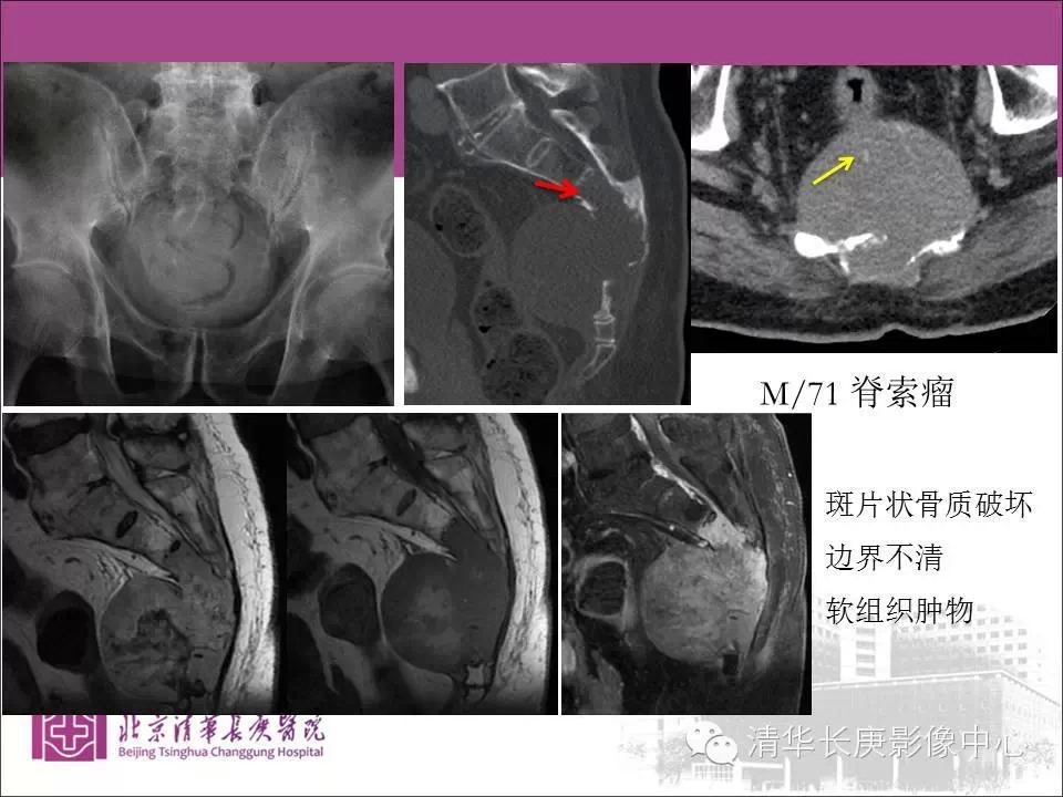 脊柱骨肿瘤的影像分析