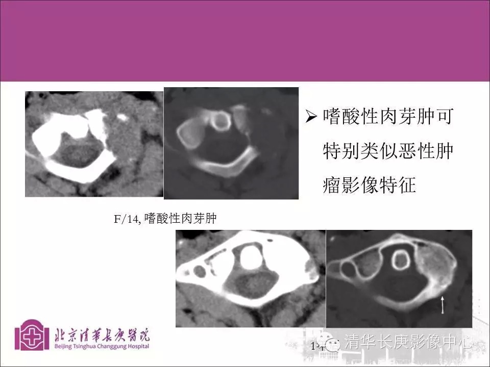 脊柱骨肿瘤的影像分析