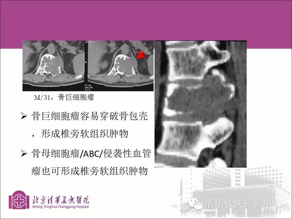 脊柱骨肿瘤的影像分析