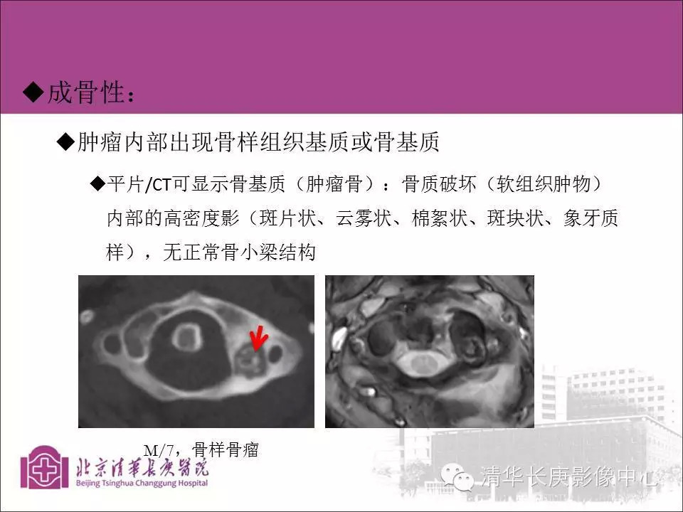 脊柱骨肿瘤的影像分析