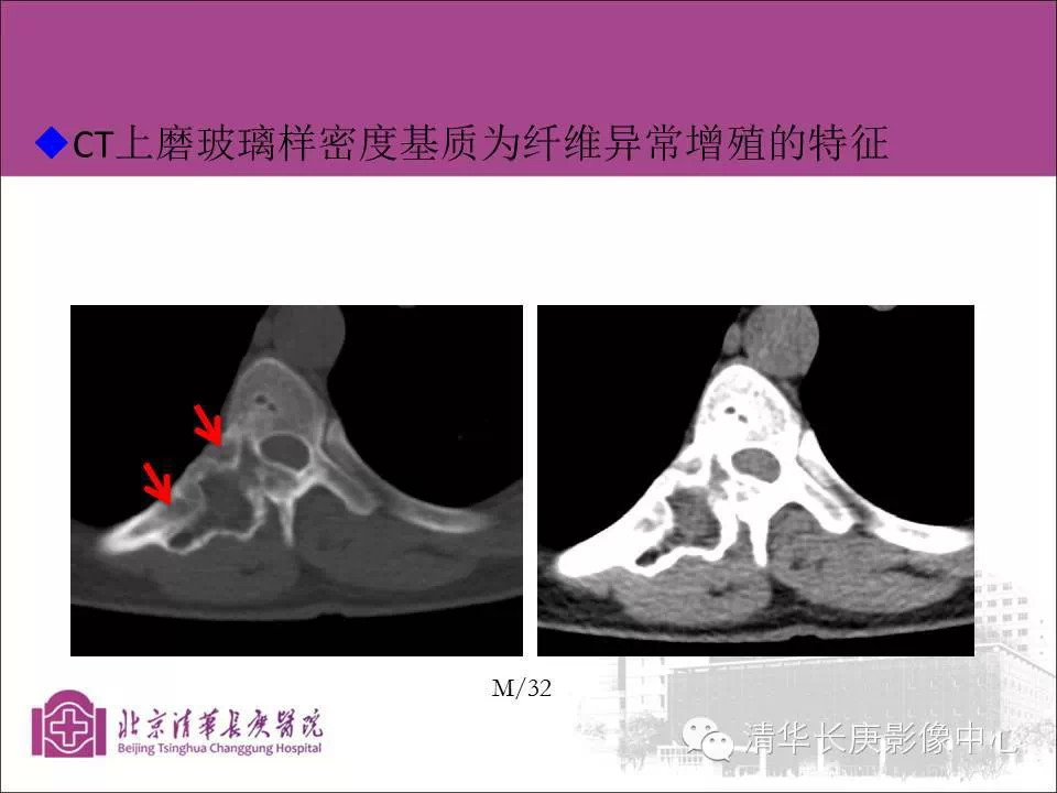 脊柱骨肿瘤的影像分析