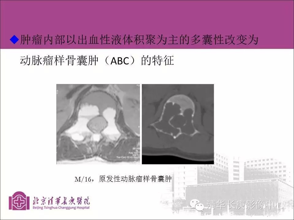 脊柱骨肿瘤的影像分析