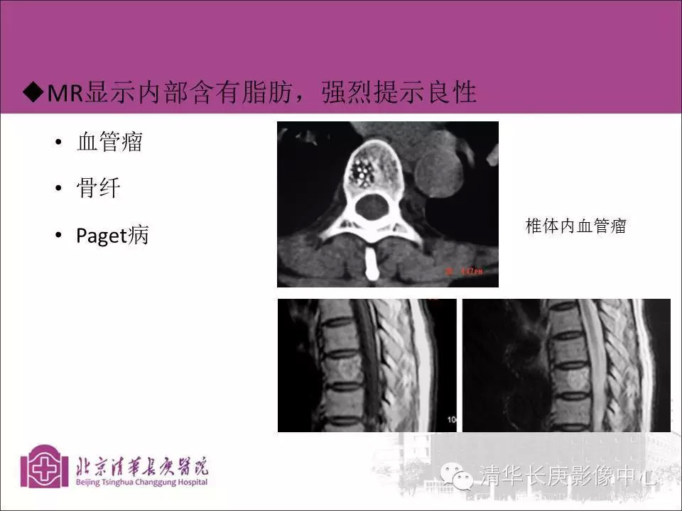 脊柱骨肿瘤的影像分析